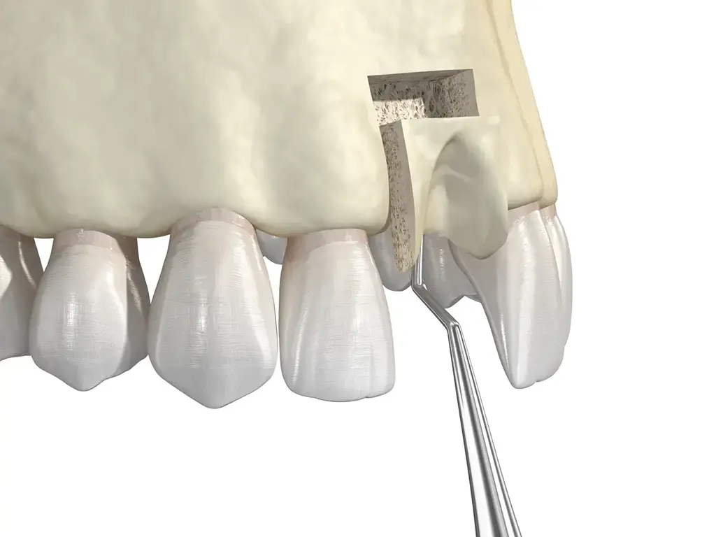 Affordable Bone Grafting Near Me
