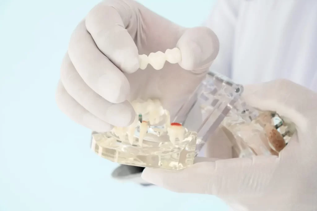 Affordable Dental Bridges