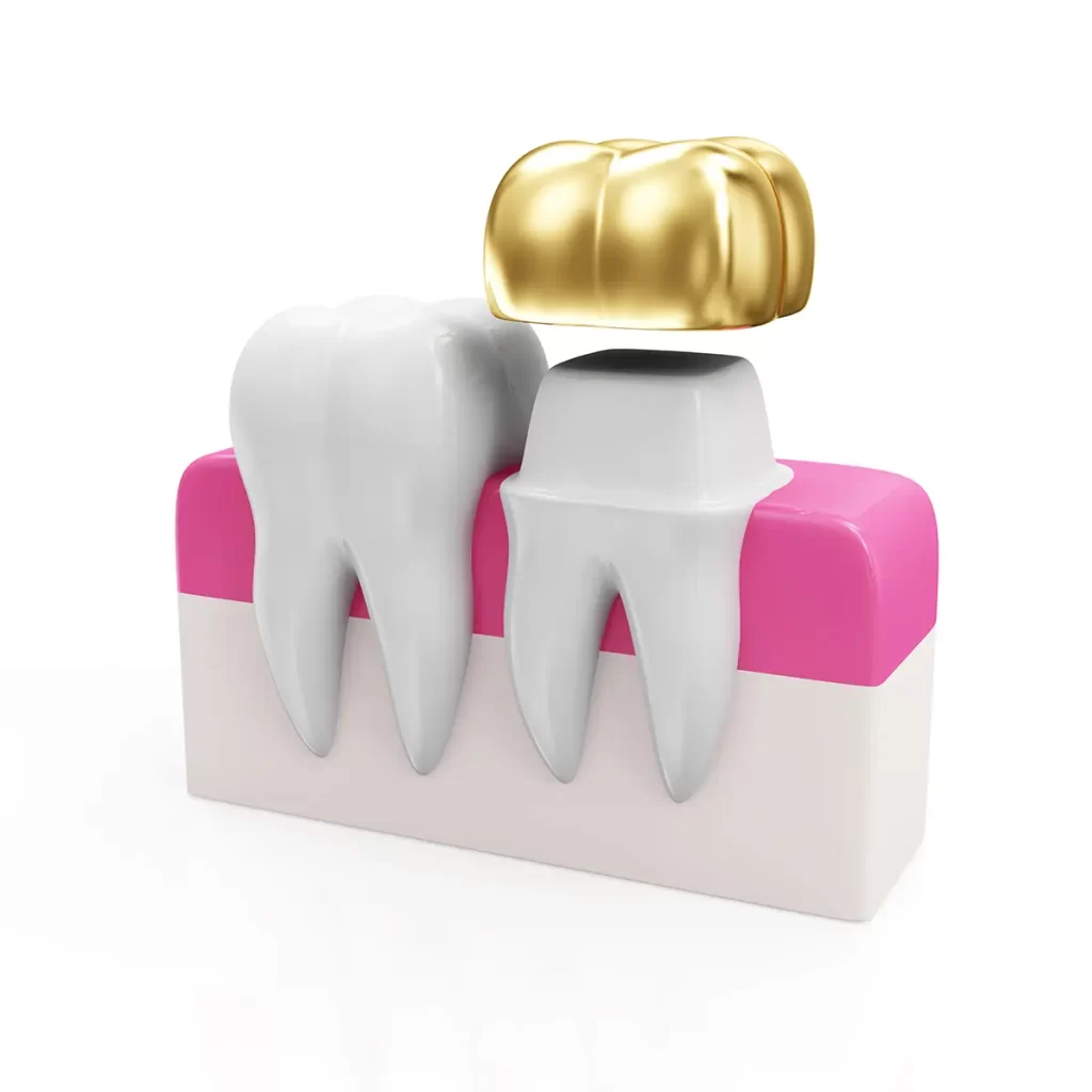 Affordable Dental Crowns