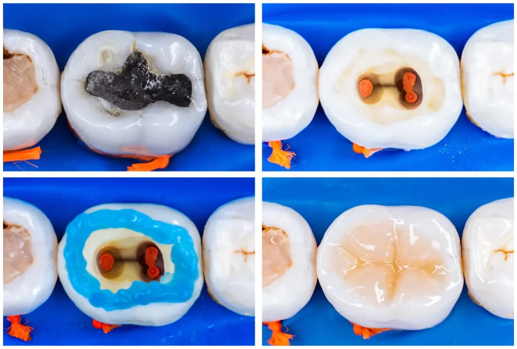 Tooth Cavity Removal