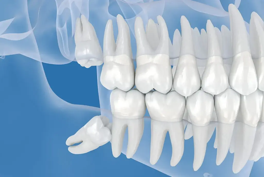 Best Wisdom Tooth Extractions Near Me