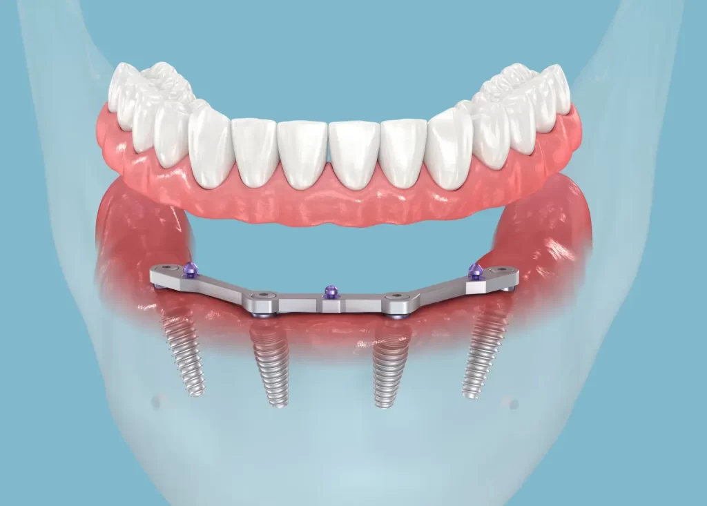 Affordable All On 4 Dental Implants