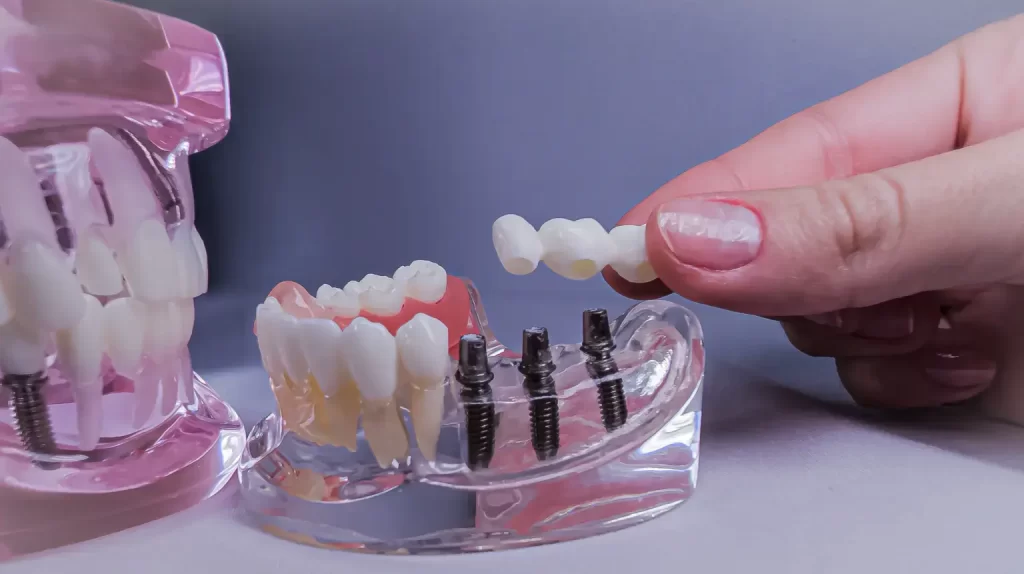 Replacing Missing Teeth Near Me