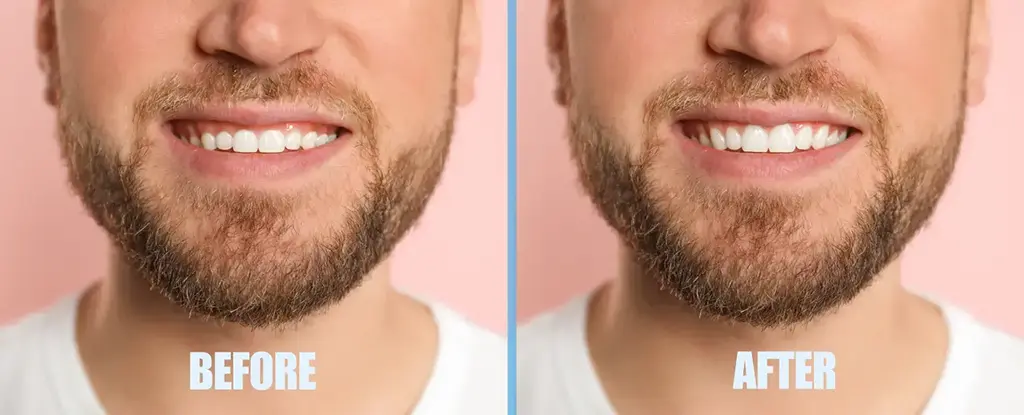 before and after Crown Lengthening