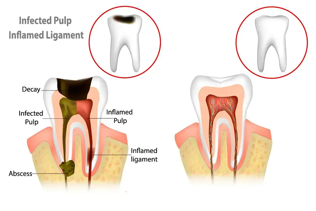 Endodontic Treatment Near Me