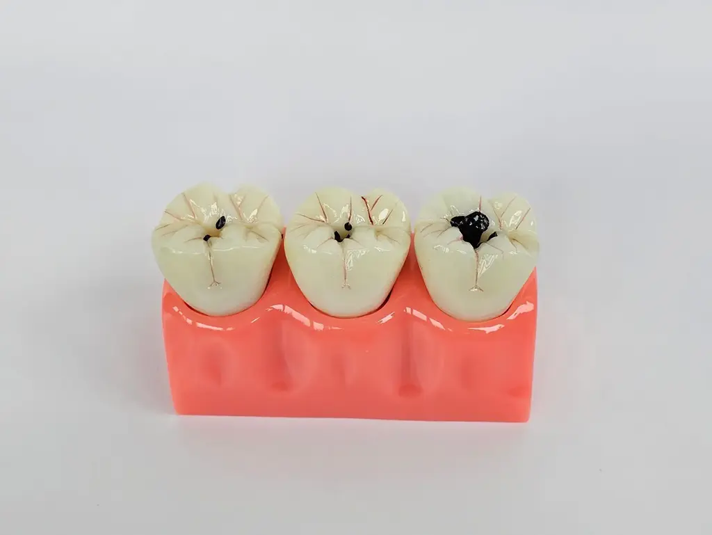 Affordable Dental Fillings Plano TX