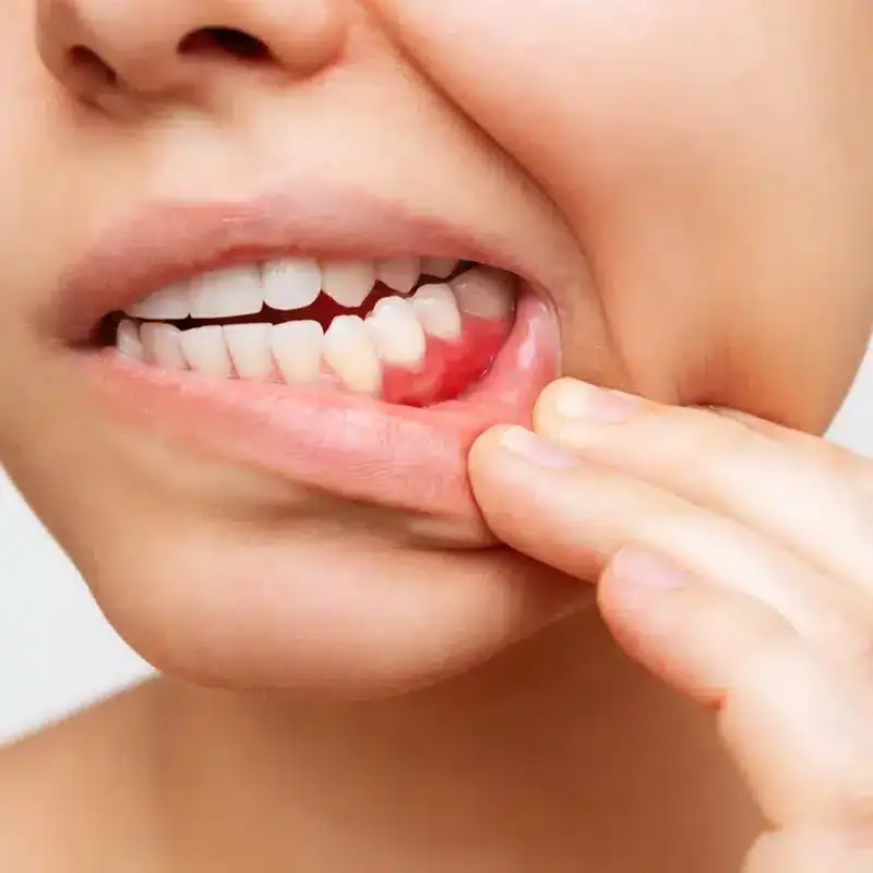 Gum Disease Treatment Plano TX