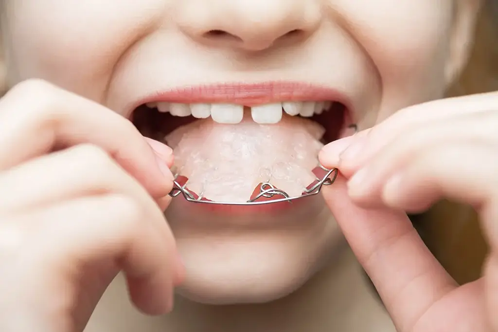 Affordable Dental Retainers In Plano