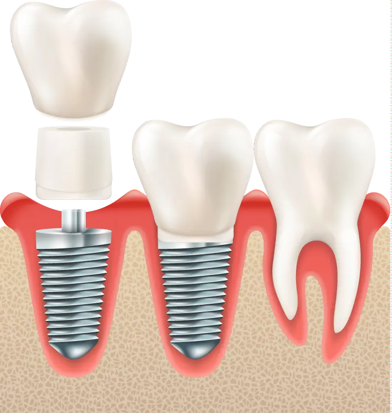 Dental Implants In Plano