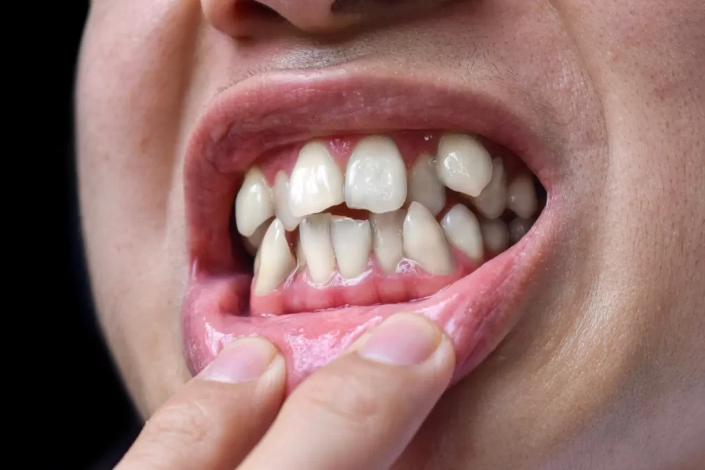 Best Cosmetic Dental Implants