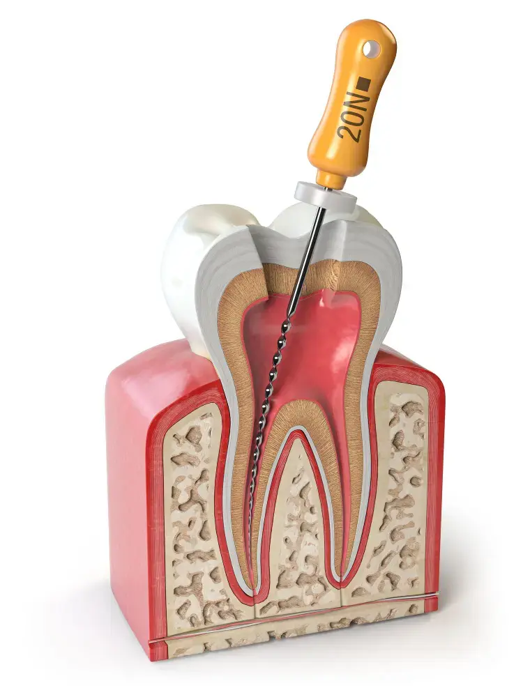 Root Canal Garland TX