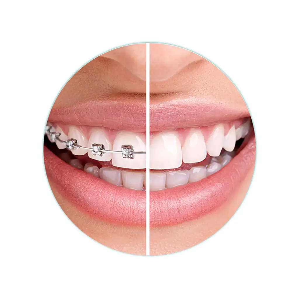 Benefits of Dental Metal Brackets