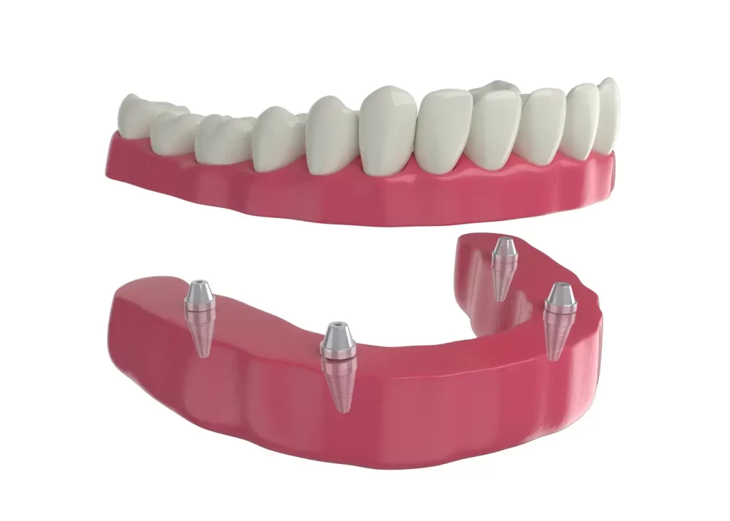 All On 4 Dental Implants