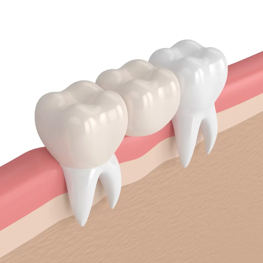 Dental Bridges