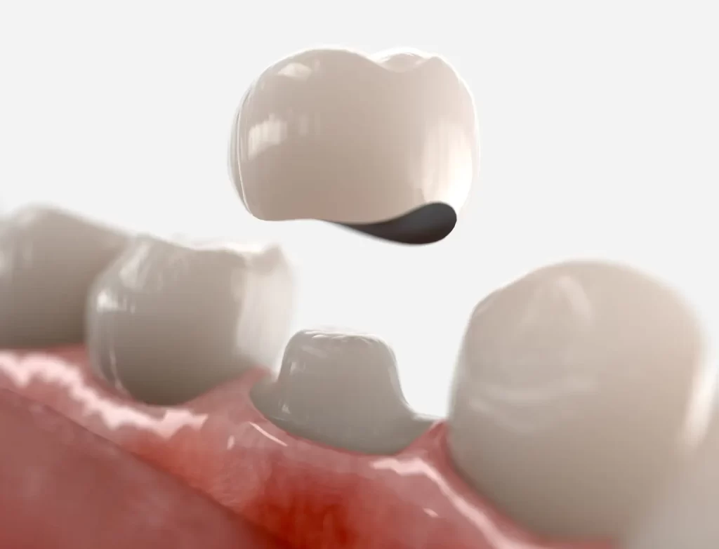 Dental Crowns