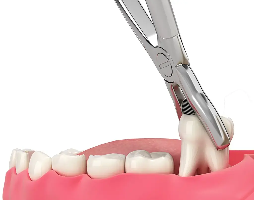 Dental Extractions In Plano