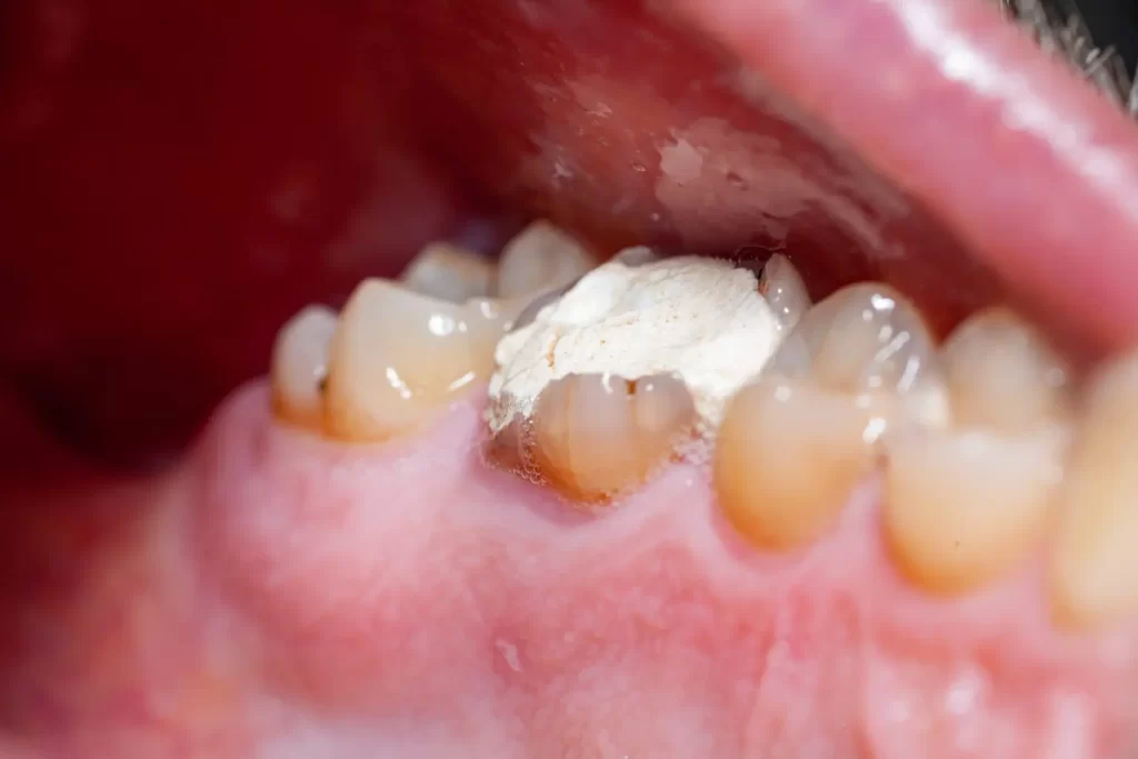 Cosmetic Dental Filling