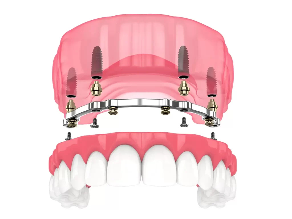 Implant Over Dentures
