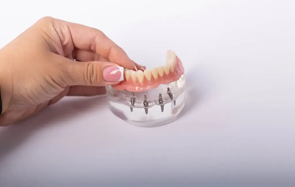 Implant Over Denture In Plano