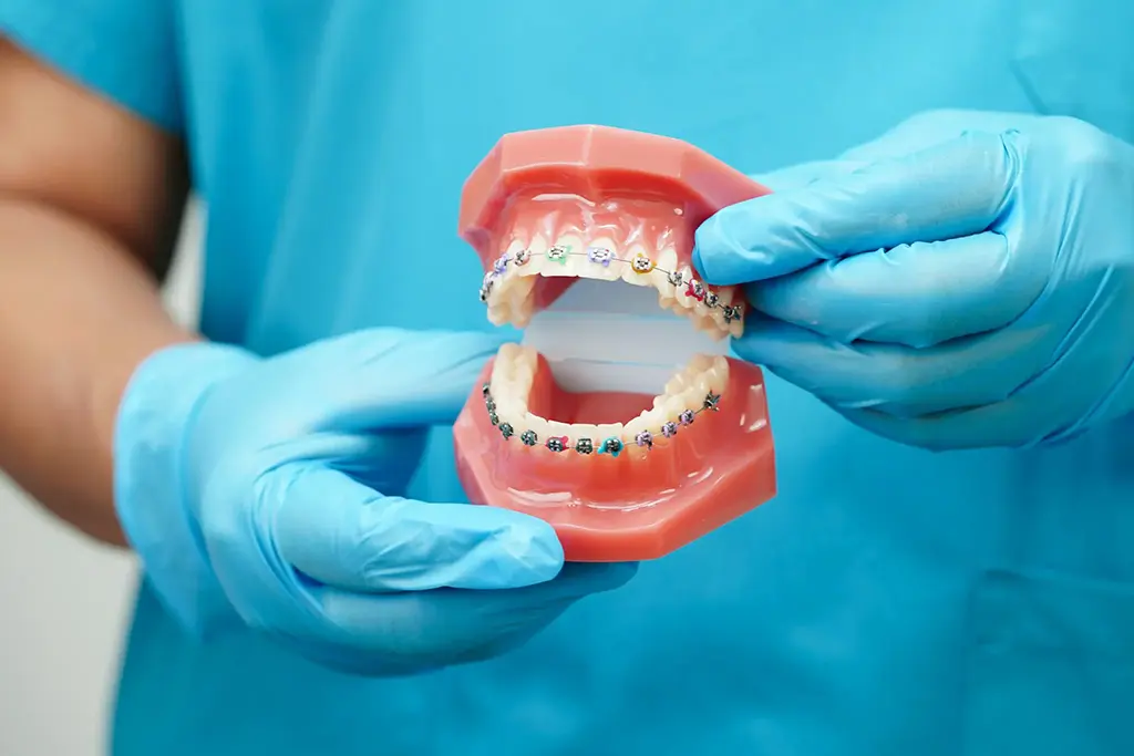 Metal Braces In Plano