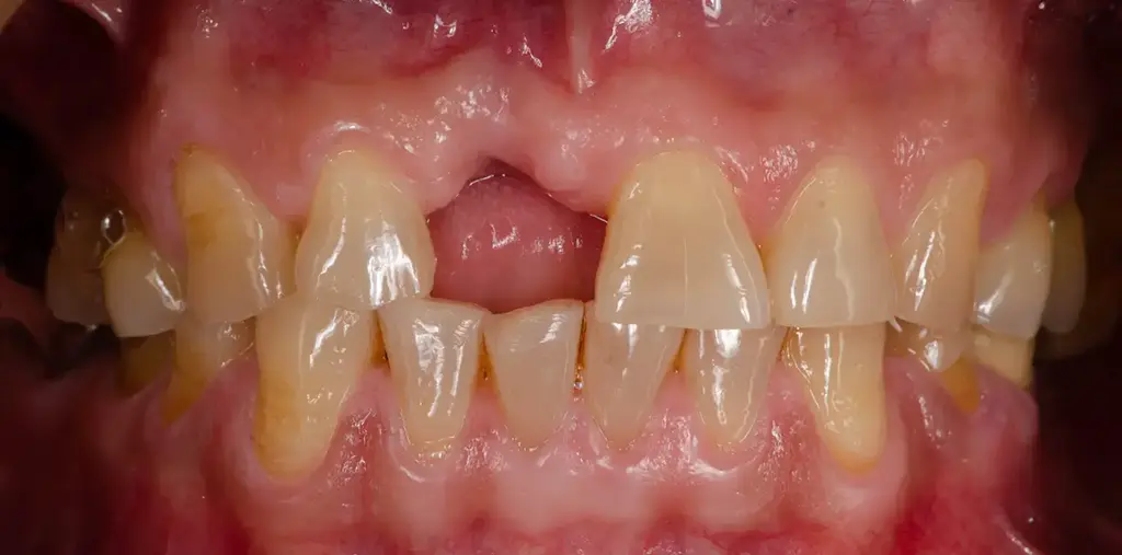 Replacing Missing Teeth In Garland