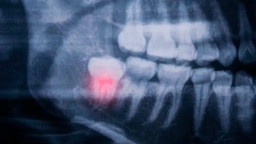 Wisdom Tooth Extraction In Plano