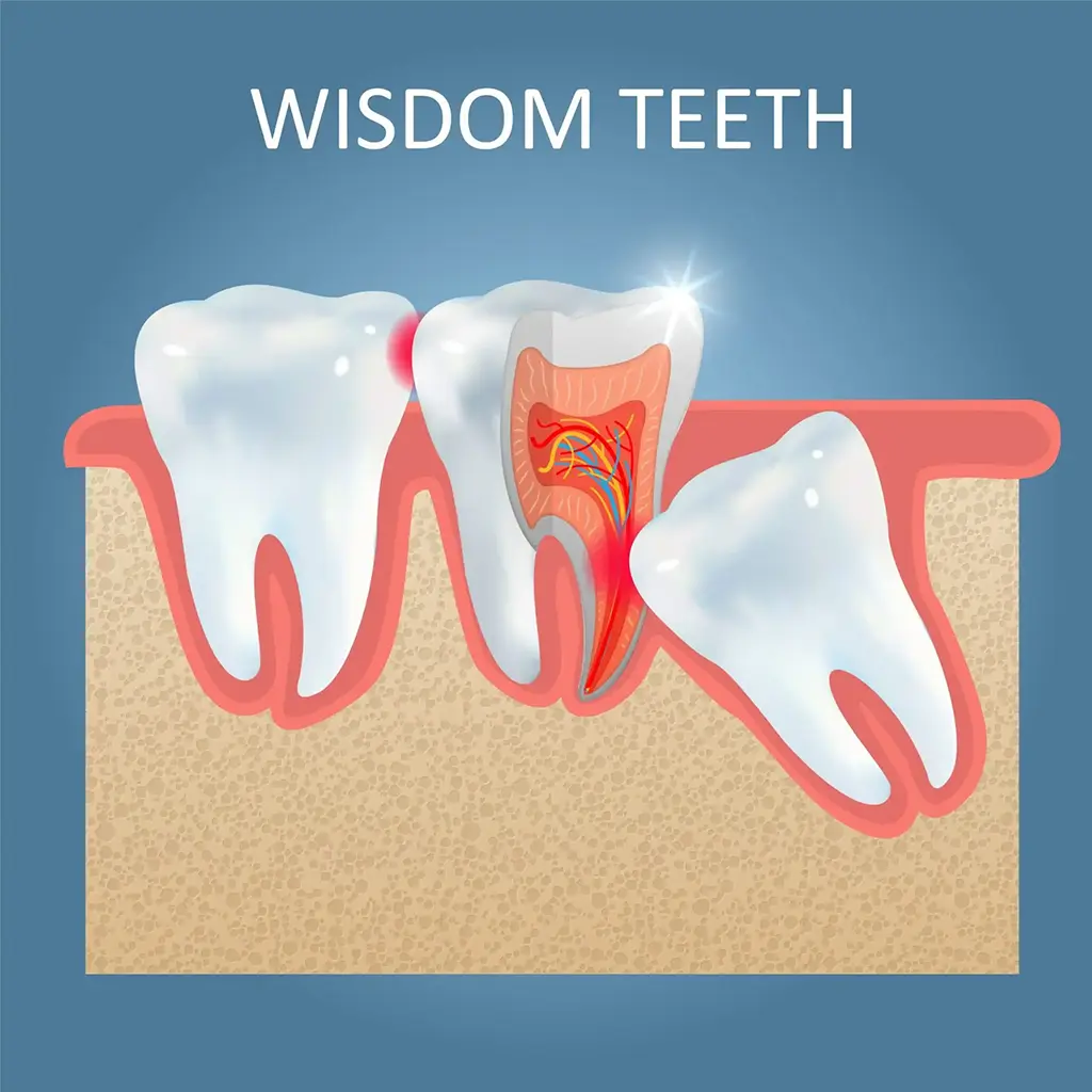 Wisdom Tooth Extractions