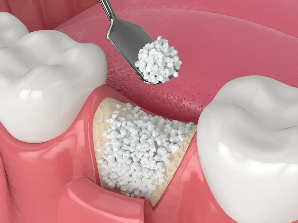 Affordable Bone Grafting