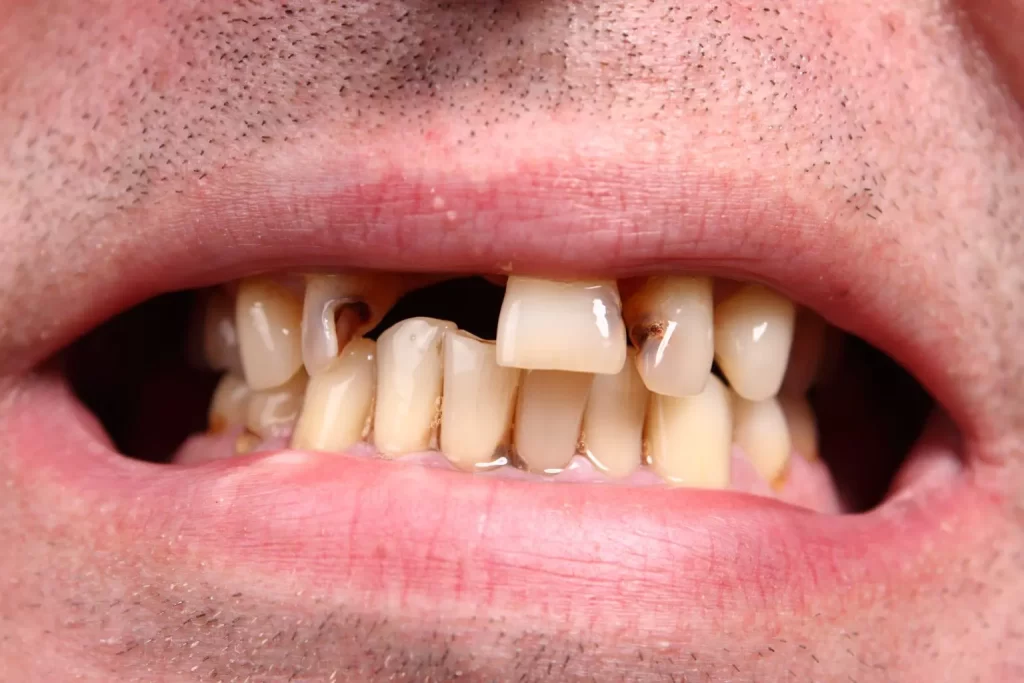 Cosmetic Dental Implants
