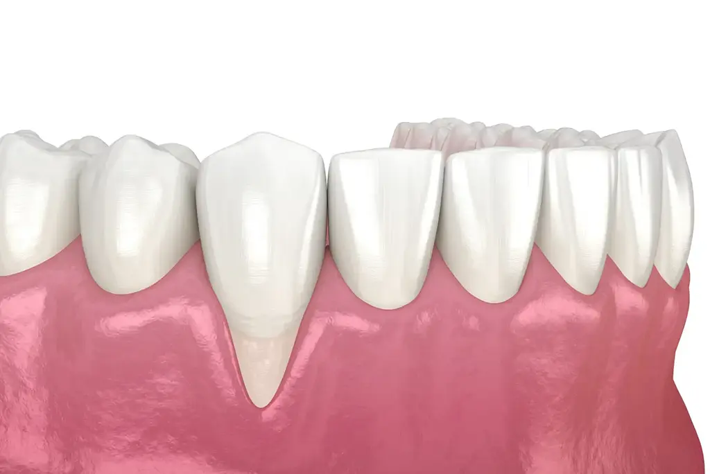 Crown Lengthening In Plano