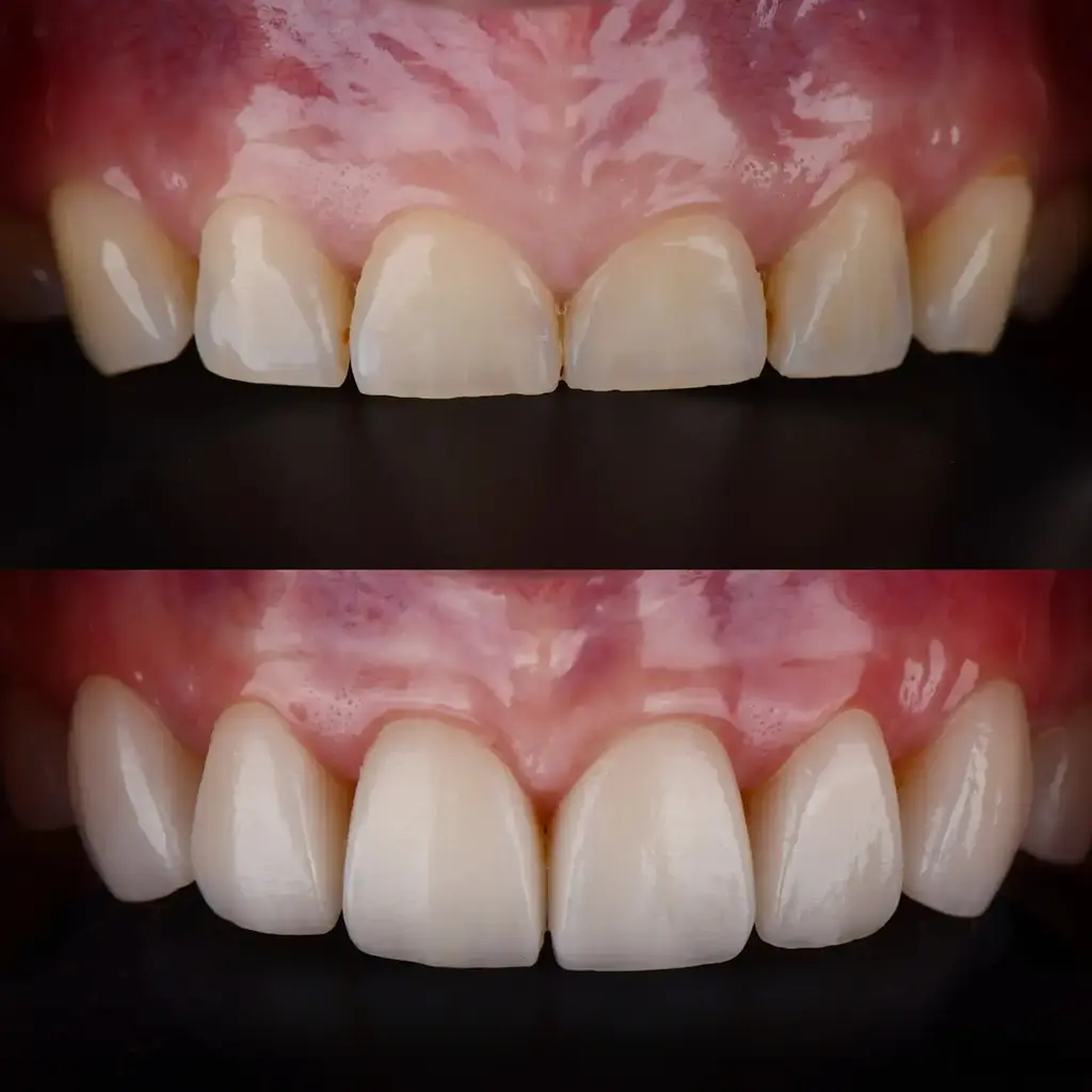 Surgical Crown Lengthening