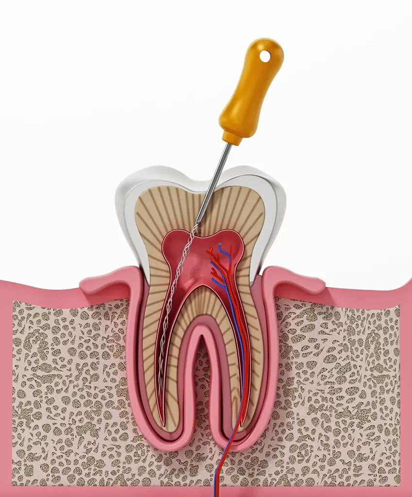 Endodontic Treatment In Plano