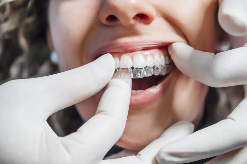 Affordable Invisible Aligners