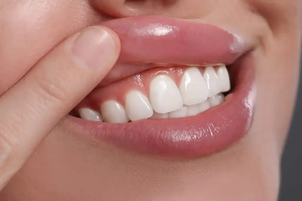 Laser Gum Contouring In Garland