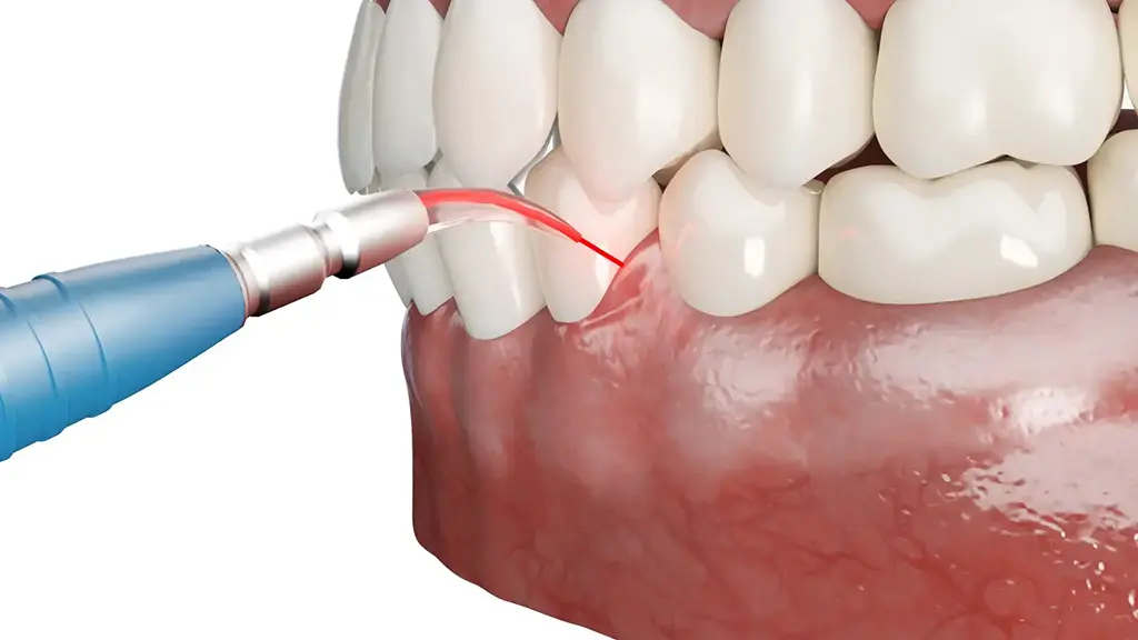 Affordable Laser Gum Contouring