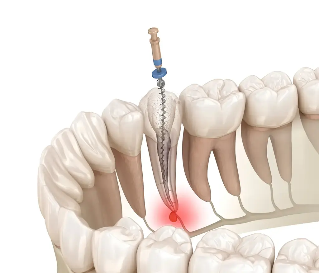 Root Canal Therapy In Garland