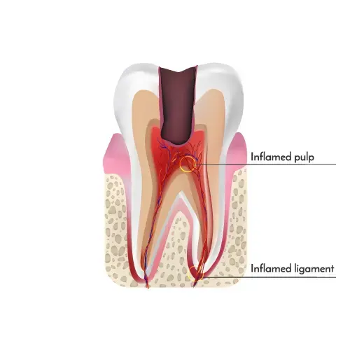 Root Canal Therapy In Plano