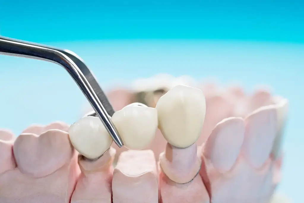 Dental Bridge Plano In TX