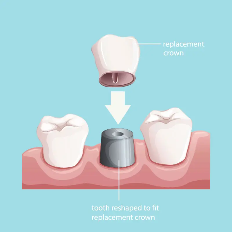 Dental Crowns In Plano