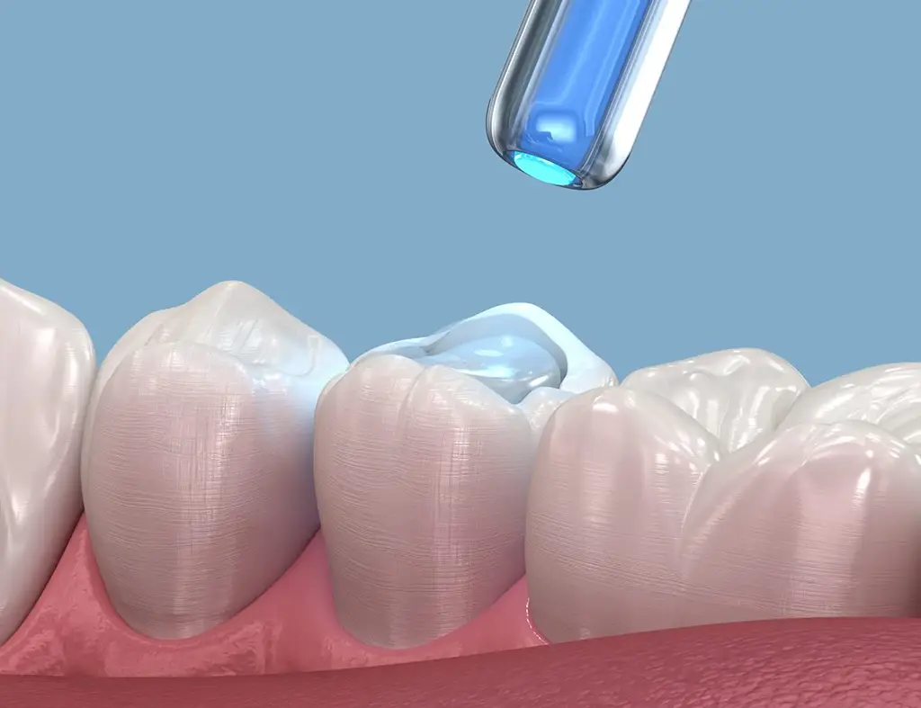 Dental Fillings In Plano