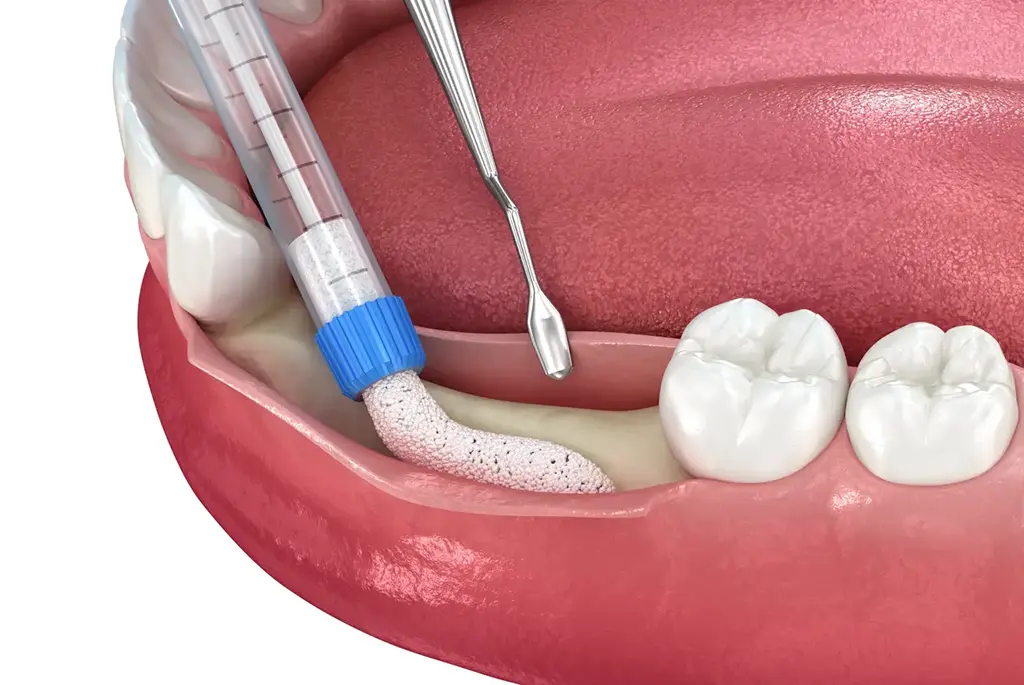 Affordable Bone Grafting Before Dental Implants