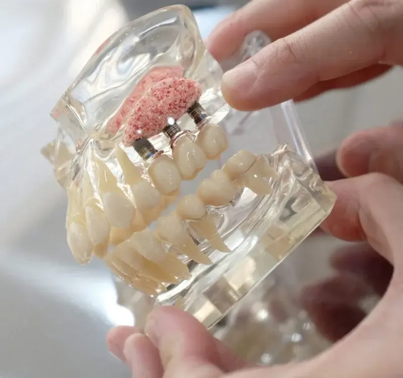 Affordable Teeth Implants for Missing Teeth