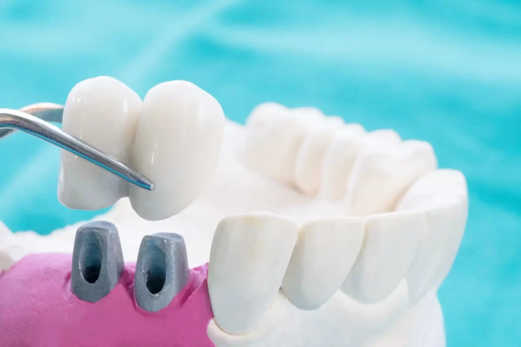Types of Dental Bridges Explained