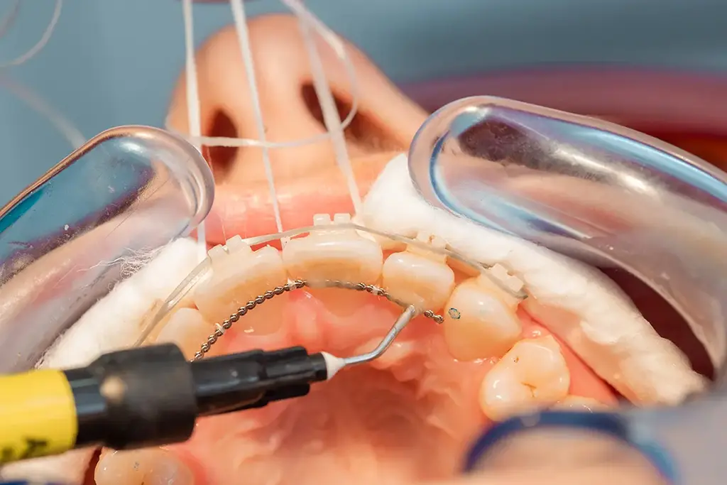 How a Dental Implant Retainer Works