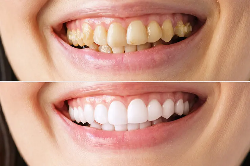 Best Teeth Whitening Dentist Near Me
