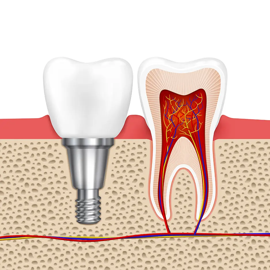 Types of Dental Crowns Explained