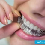 Affordable Invisible Aligners