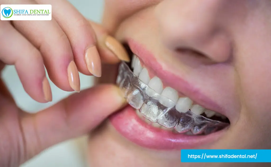 Affordable Invisible Aligners